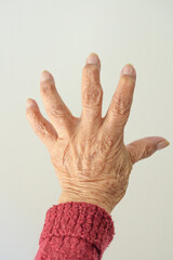 Hand of elderly woman with disfigured fingers caused by rheumatoid arthritis 