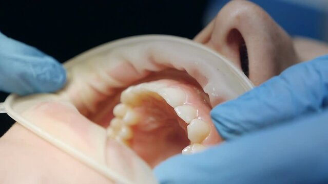 Close up of patient with cheek retractor in mouth at dental clinic. Orthodontist using dental curing UV lamp on teeth of patient. Concept of dentistry and orthodontic treatment