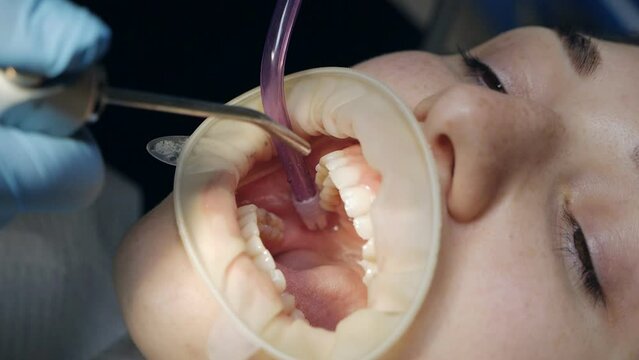 Young woman with a retractor in her mouth in a dental clinic. Brushing teeth with water. Dentist using saliva ejector or dental pump