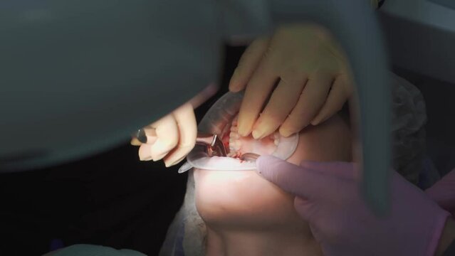 real. dentist pulls out a sick wisdom tooth. 