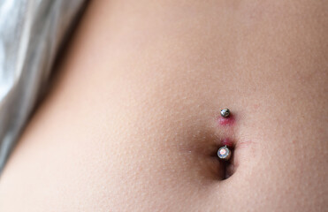 Closeup on belly button piercing infection
