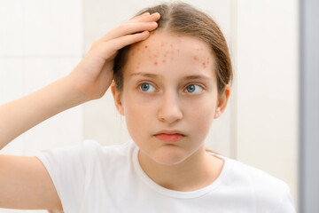 portrait of a teenage girl touches her face with pimples, acne on the skin