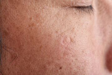 Skin problem with wrinkle and pigmentation, Close up men face with acne and dry skin, Large pore...