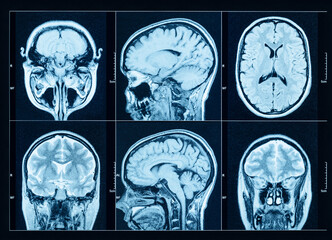 Closeup of a CT scan with brain. Medical, science and education mri brain background. Magnetic resonance imaging.