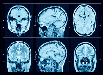 Closeup of a CT scan with brain. Medical, science and education mri brain background. Magnetic...
