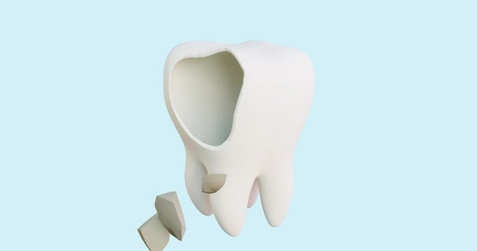 3d animation of tooth enamel destruction in stages spot, caries, dentin lesion, hole, treatment, filling, molar treatment, restoration, blue ribbon shows a whole tooth