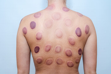 Woman's back with hematomas marks after taking cupping therapy.  After vacuum cans