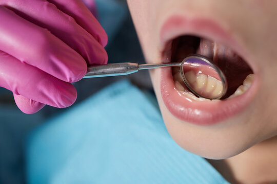 A close-up of a young girl getting a dental exam by dentist and using dental mirror to see baby teeth and gums.
