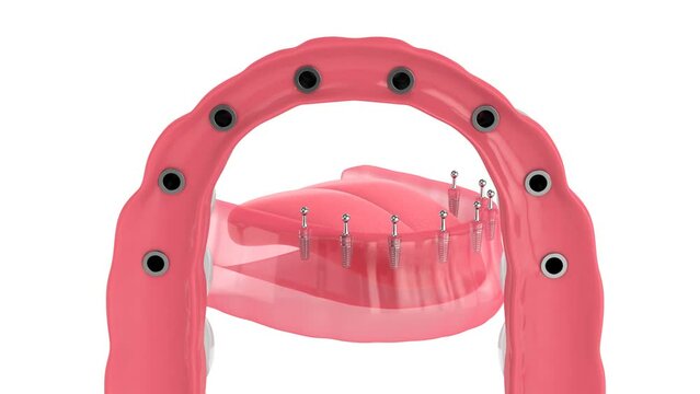 All-on-8 removable, implants supported, overdenture installation