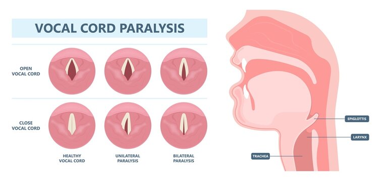 Sore loss cough virus viral acute swell sound folds treat cysts Palsy nerve Tumor botox throat hoarse larynx airway polyps Cancer injury speech damage Ulcers box chronic nodules surgery reflux upper