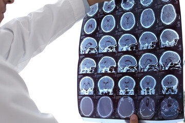 Doctor examining MRI images of patient with multiple sclerosis in clinic, closeup