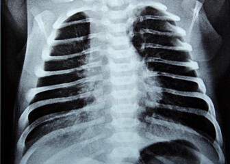 Selective focus of a plain chest x ray for a newborn infant in incubator with a right lung...