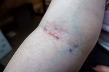Fototapeta premium Close up view of a caucasian female's arm after having blood drawn from the same vein twice in one day, causing severe skin irritation