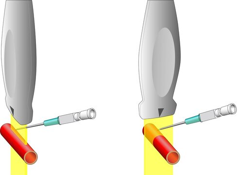 超音波ガイド下穿刺：長軸像と短軸像のイラスト(カラー版)