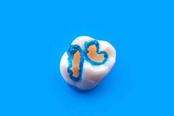 tooth etching before starting composite restiration