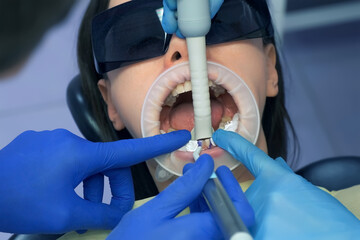 Dentist is washing out blue acid from woman's teeth before installing veneersand ceramic crowns....