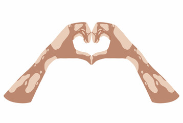 Hands with vitiligo disease. Support for people with skin pigmentation disorders. Heart, self-love and body positive. Light skin, mutalka. Body positive. Hand drawn illustration. Vector