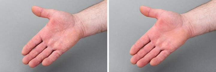 Dry man's hand with skin peeling off. Before and after eczema dermatitis treatment.