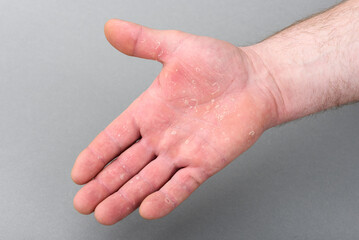 Fototapeta premium Dry man's hand with skin peeling off. Eczema dermatitis.