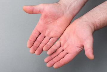 Dry man's hand with skin peeling off. Before and after eczema dermatitis treatment.