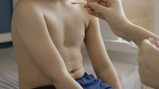 Mother applying antiseptic cream onto boy body skin. Varicella virus or Chickenpox bubble rash on child. The child has chickenpox and is sitting on bed in children room. Close-up shot.