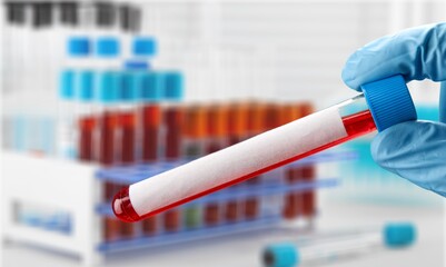 Analysis lab sample of new strain of Coronavirus Omicron.