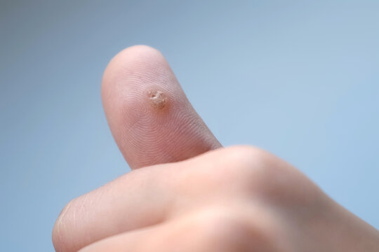 Big wart, verruca on human thumb finger before laser removing on grey backgroung, closeup view. Human papillomavirus, weakened immunity, treatment of warts. An infectious disease.