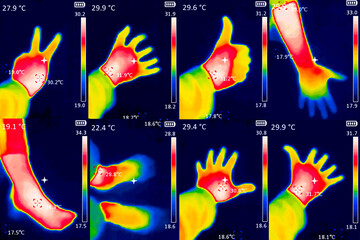 A thermographic image of a person's hand showing different temperatures in different colors, from blue indicating cold to red indicating hot, this may indicate inflammation of the joints. Collage - obrazy, fototapety, plakaty