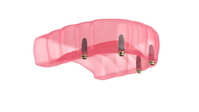 Bar retained removable overdenture installation supported by implants