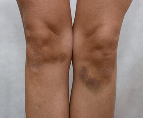 bruise on the skin of the legs on the knees