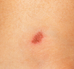 Fototapeta premium scratch on the skin of a child's foot