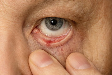 Eye of a man, inflamed conjunctiva, close-up. Eye diseases.