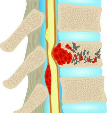 Metastatic spinal cord compression