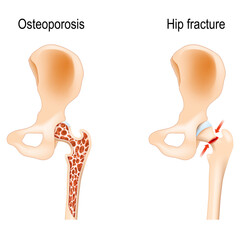 Osteoporosis that caused of Hip fracture