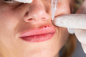 Young lady getting botox injection for bigger, fuller lips. The woman in the beauty salon. Plastic surgery clinic.