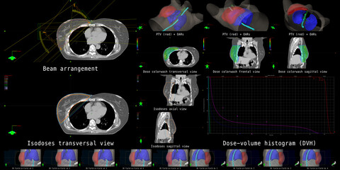 The overview shows beam configurations, dose calculations and dose distributions for postoperative radiotherapy of a breast cancer patient. - obrazy, fototapety, plakaty