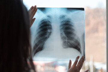 X-ray of the lungs in the hands of a pneumologist. A lung shot shows a shadow on the lungs - 484521608