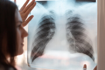 X-ray of the lungs in the hands of a pneumologist. A lung shot shows a shadow on the lungs - 484521610