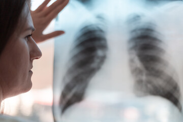 X-ray of the lungs in the hands of a pneumologist. A lung shot shows a shadow on the lungs - 484521820