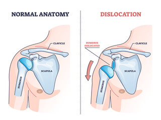 Shoulder dislocation and humerus bone trauma explanation outline diagram. Labeled educational medical injury when skeletal part rotates out of scapula vector illustration. Painful arm vs healthy. - obrazy, fototapety, plakaty