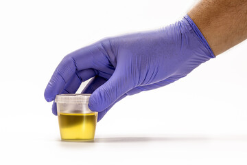 collection bottle with urine being handled by blue gloved hand, EAS urine test - Abnormal Sediment Elements, serves to analyze the pH of the urine. lab exam