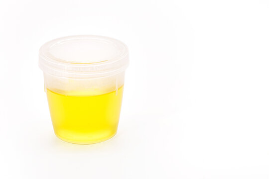 urine for examination collected in disposable plastic bottle, laboratory analysis, medical checkup