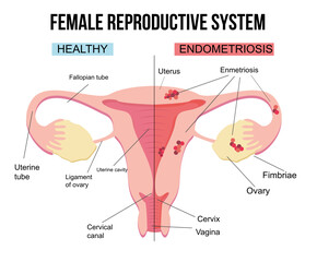 Obraz premium Female reproductive system, endometriosis.Scheme of gynecological diseases of the uterus.The state of growth of external tissues within the female body. Structure with painful sick and healthy example