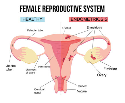 Female reproductive system, endometriosis.Scheme of gynecological diseases of the uterus.The state of growth of external tissues within the female body. Structure with painful sick and healthy example