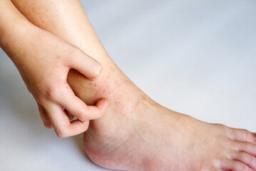 Allergy skin at ankle of an Asian kid with her hand to scratch in natural light.
