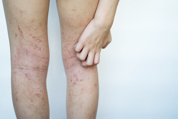 Allergy skin of an Asian kid on her legs with hand to scratch in natural light.