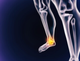 When inflammation strikes. A cgi view of an inflamed joint isolated on blue.