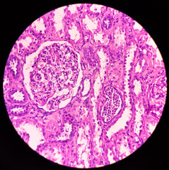 Kidney cancer: Show malignant neoplasm, clear cell carcinoma, fuhrman nuclear grade-I, renal cell carcinoma in between renal tubules, microscopic 40x view