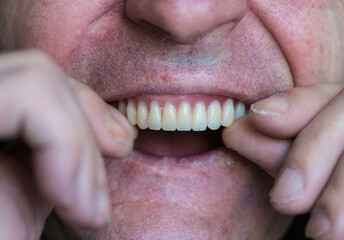 Fototapeta premium Portrait of a caucasian man over 70 years old trying on removable dentures. A man puts on a set of false teeth.Dental practice.Selective focus