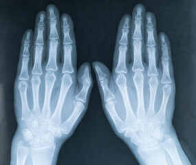 X-ray of two human hands. X-ray image of the hands of a senior woman with Osteoarthritis